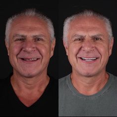 Resultado antes e depois de caso clínico