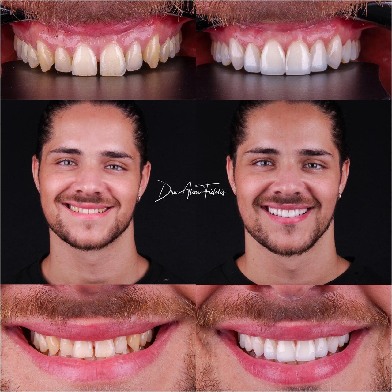 Caso clínico antes e depois, lentes em resina composta