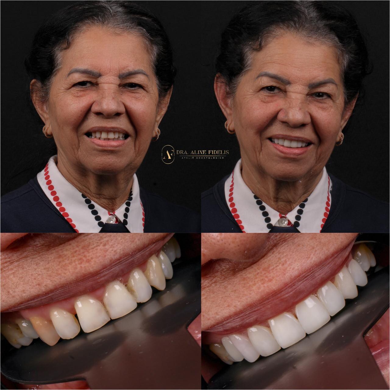 Caso clínico antes e depois, lentes em resina composta