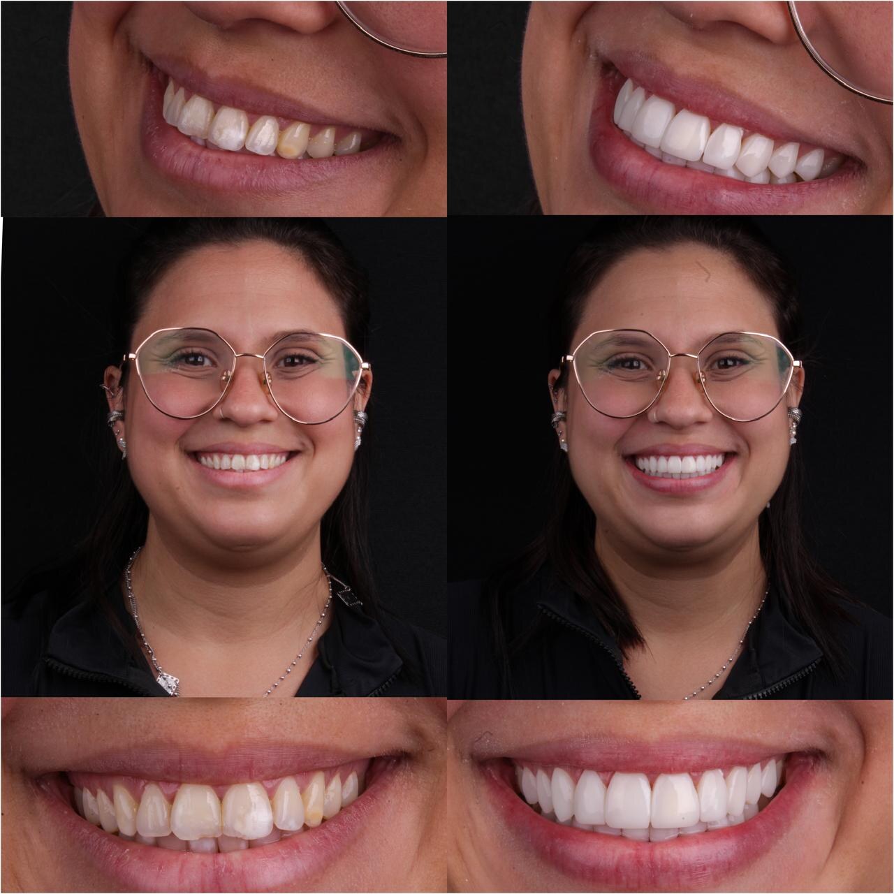 Caso clínico antes e depois, lentes em resina composta