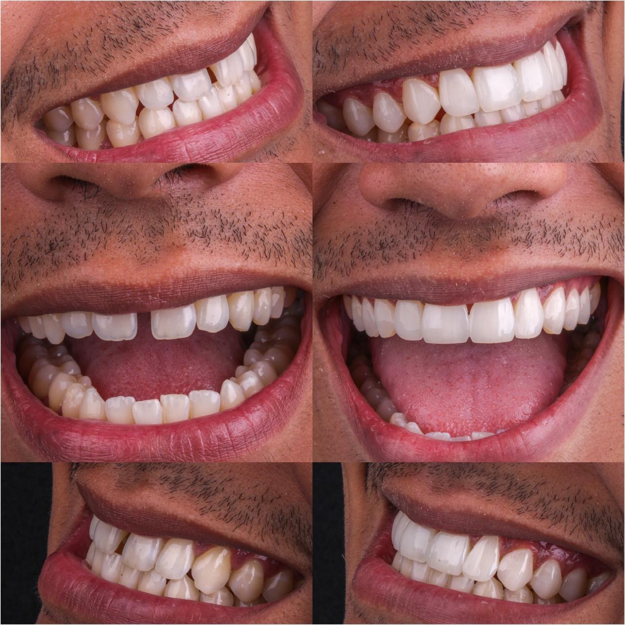 Caso clínico antes e depois, lentes em resina composta