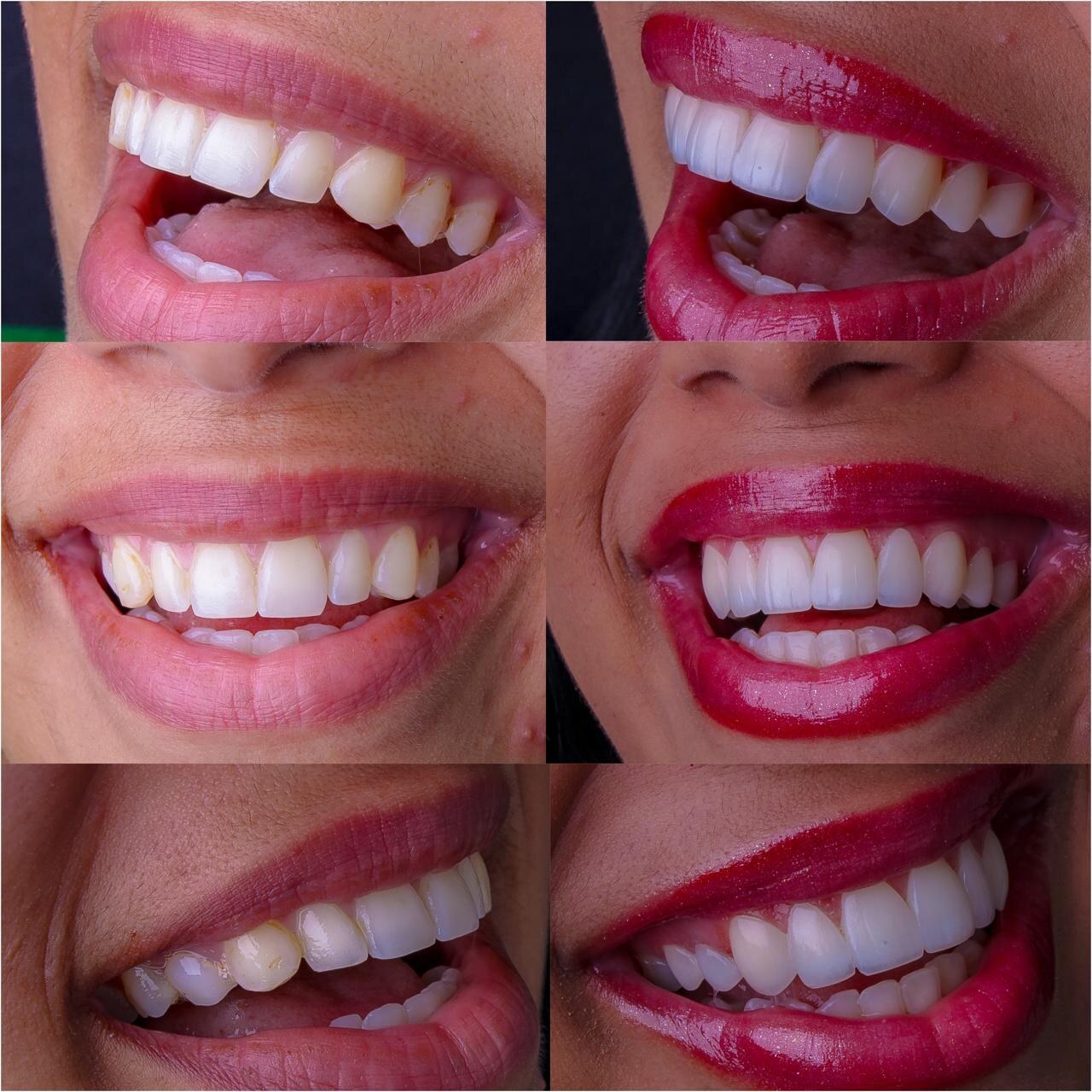 Caso clínico antes e depois, lentes em resina composta