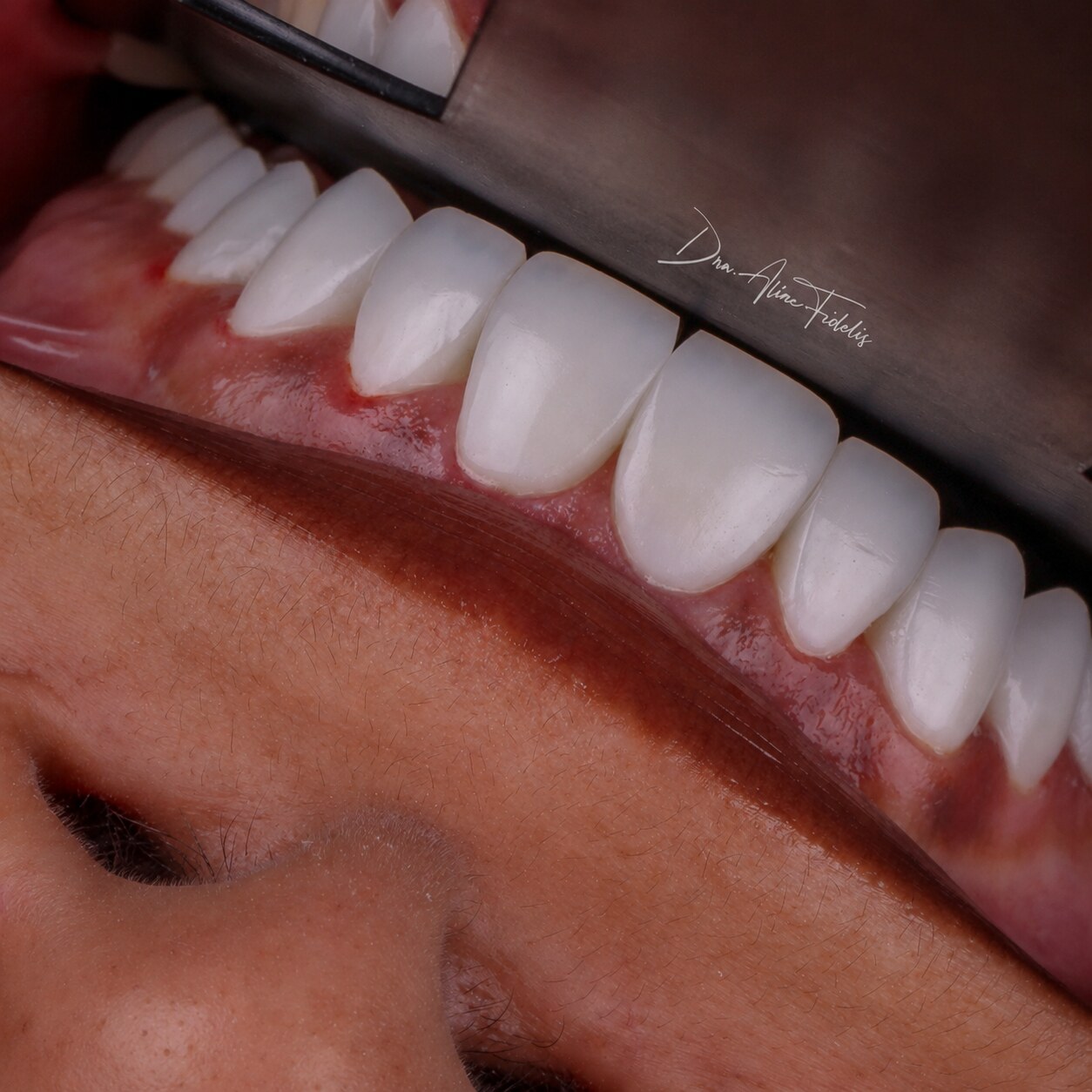 Detalhe de acabamento e anatomia em lentes de resina